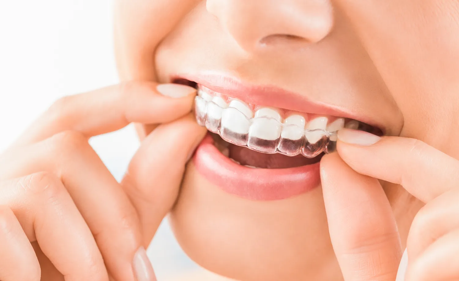 Invisalign Lublin cena